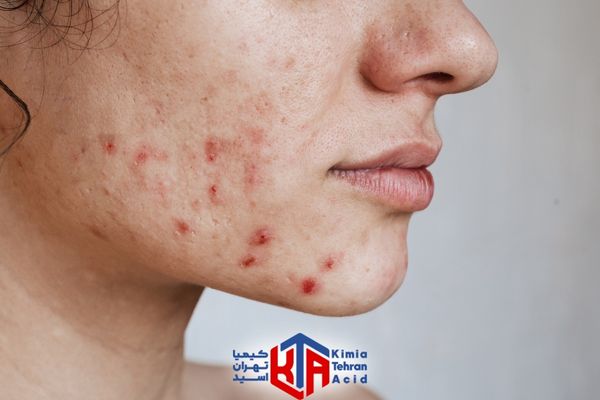 زاج سفید برای جوش صورت
